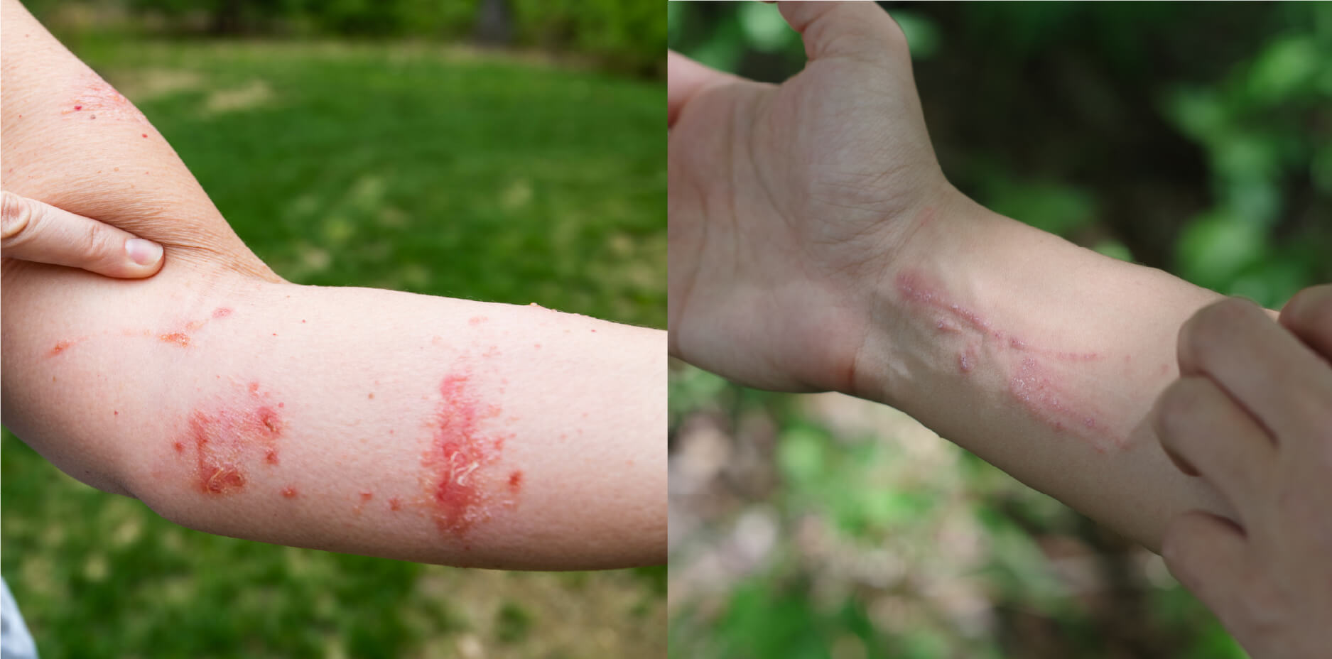Two images showing examples of poison ivy and poison oak rash. The first image is of patchy hives and blisters on a woman's forearm. The second image is of dry scratch-like lines on a man's wrist.