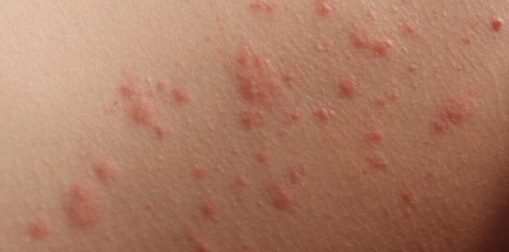 How To Clear Up Poison Ivy Rash