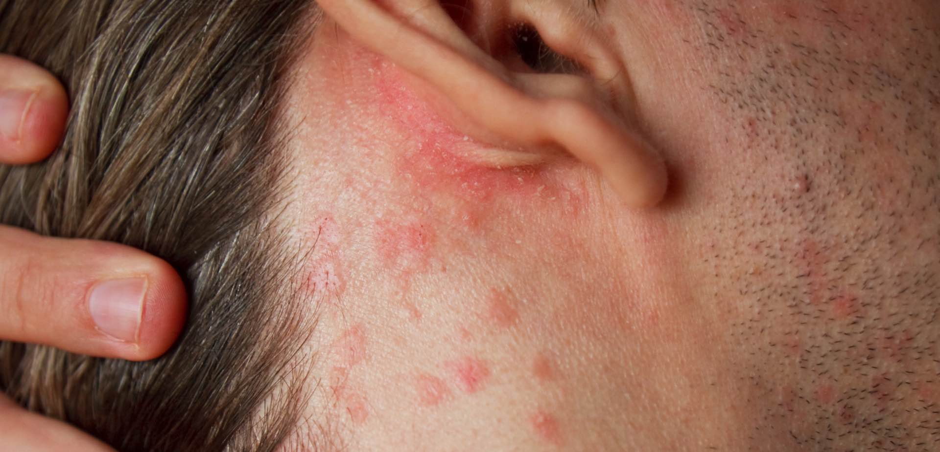 psoriasis face treatment