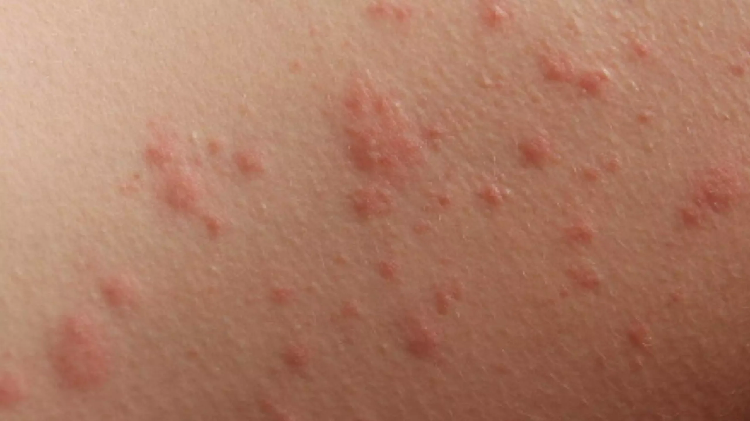 7 common summer skin rashes in children Virtuwell