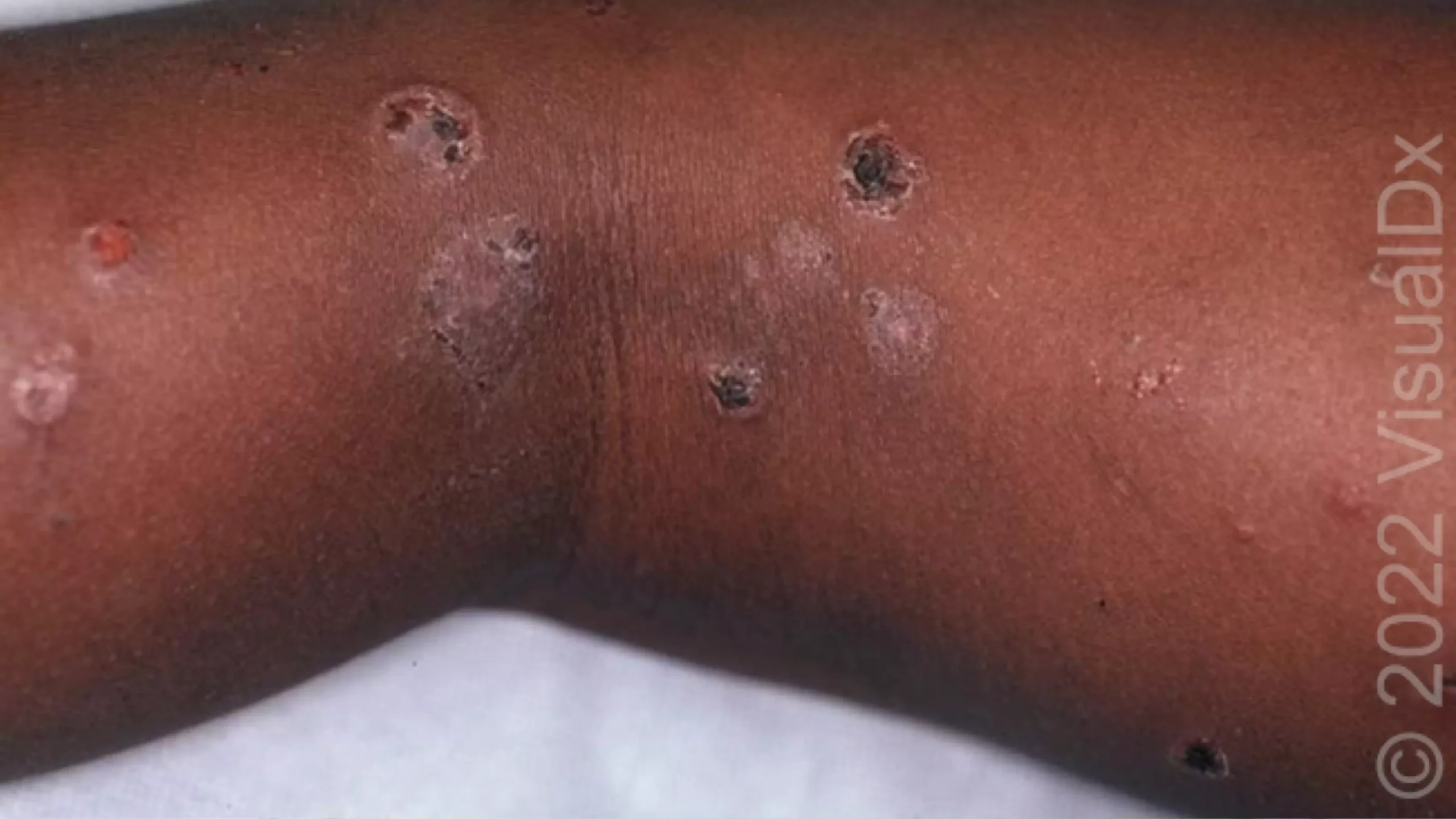 Skin Rashes in Children: Learn the Most Common Causes