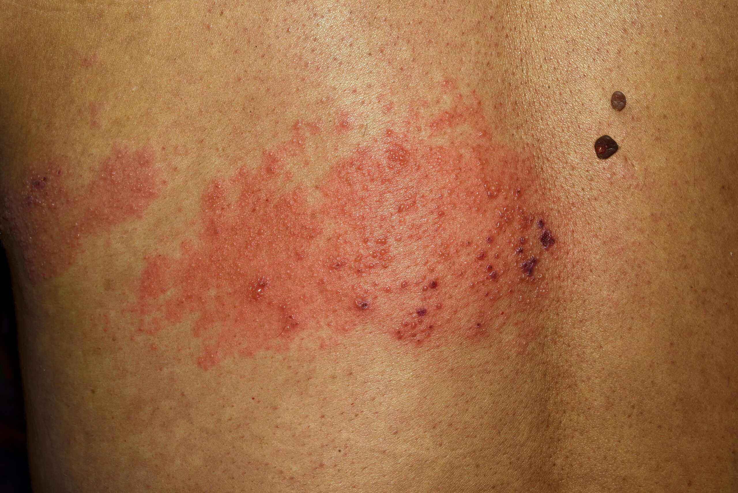 Person with shingles rash on middle-left side of back