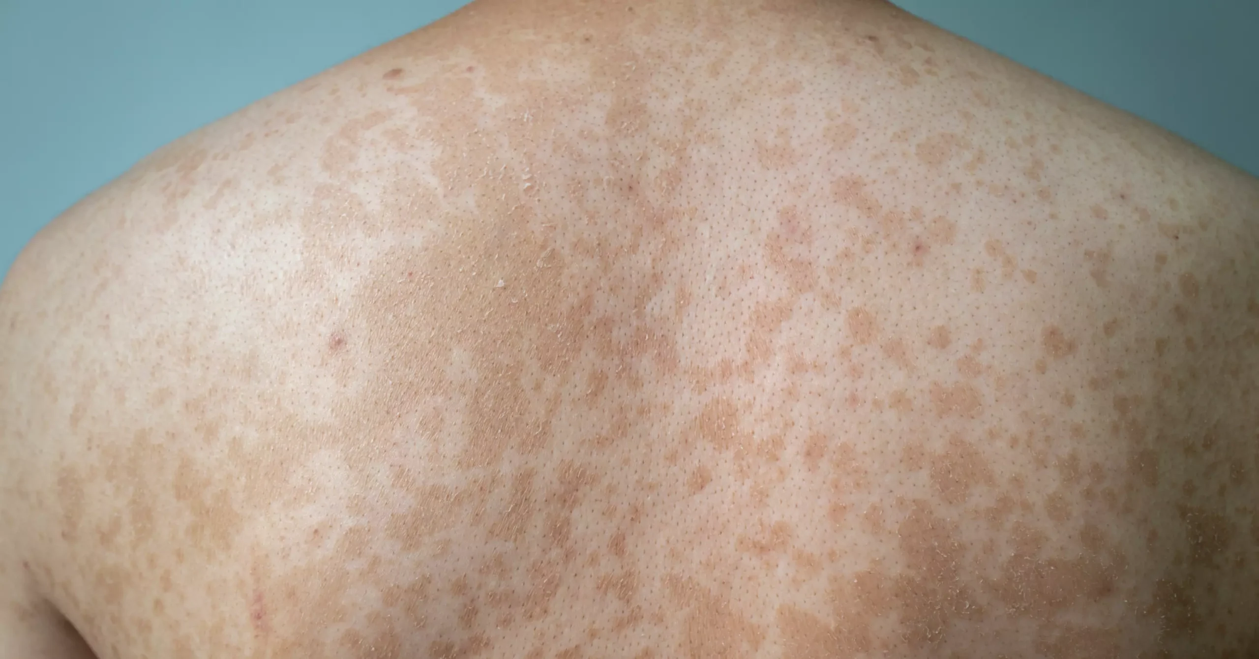 Children's Skin Center - Tinea Versicolor Ever have whitish